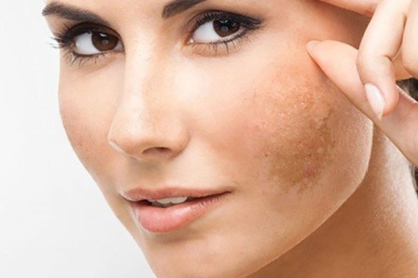 Nám da gây nên mất thẩm mỹ cho khuôn mặt.
