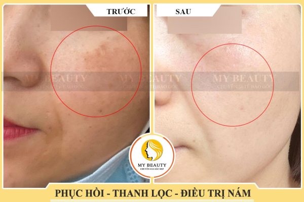 tinh chất thanh khử nám dimanlaier