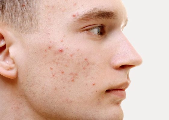 tinh chất skin acne