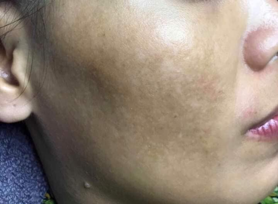 Kem Trị Nám Lightening